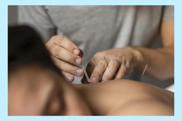 acupuntura-con-marco